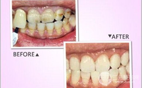 四环素牙怎么变白，有哪些比较好的方法