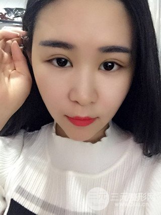 深圳全切双眼皮修复成功案例恢复过程分享