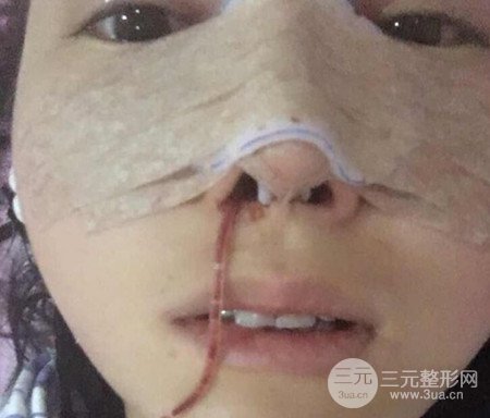 广州隆鼻整形真实恢复期图片，拥有精致美鼻不是梦