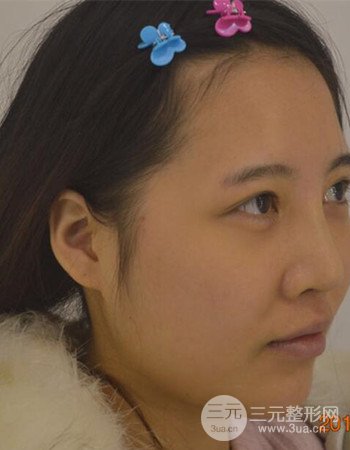 北京吸脂瘦脸真人案例恢复过程分享，巴掌小脸不是梦