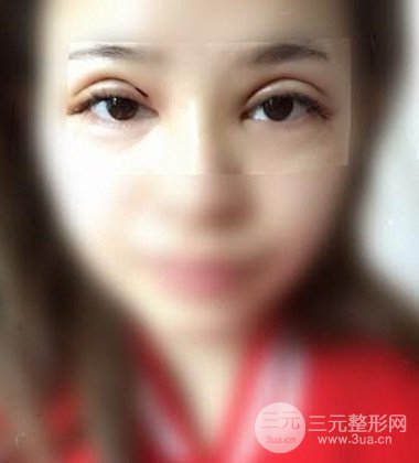 上海双眼皮手术真人案例恢复过程分享