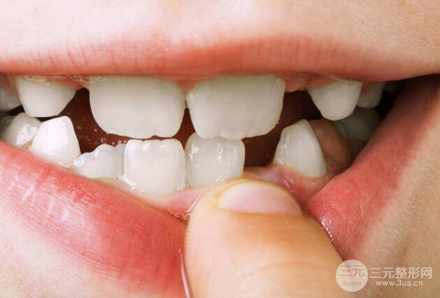 洗牙的危害有哪些?具体有什么影响?