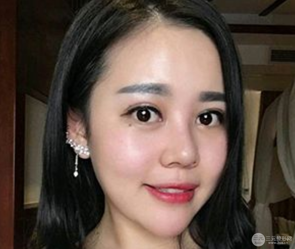 [揭秘]北京八大处靳小雷做双眼皮怎么样 效果图