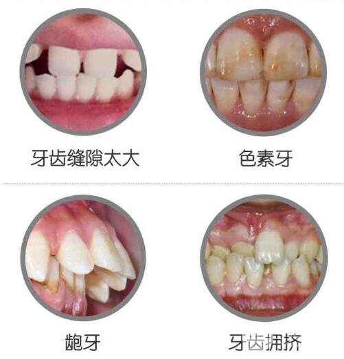 烤瓷牙属于一种比较流行的牙齿美容方法,主要针对的是牙齿畸形或者