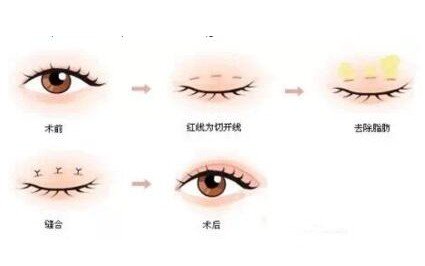 韩式微创双眼皮恢复图记录