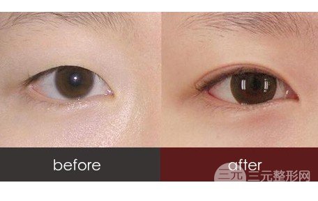 韩式微创双眼皮恢复图记录