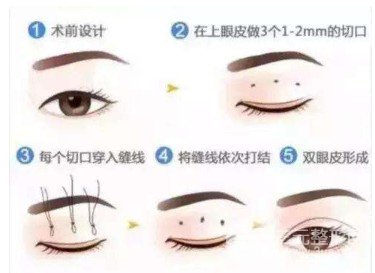 韩式定点双眼皮跟埋线的区别