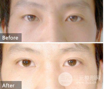 韩式定点双眼皮跟埋线的区别