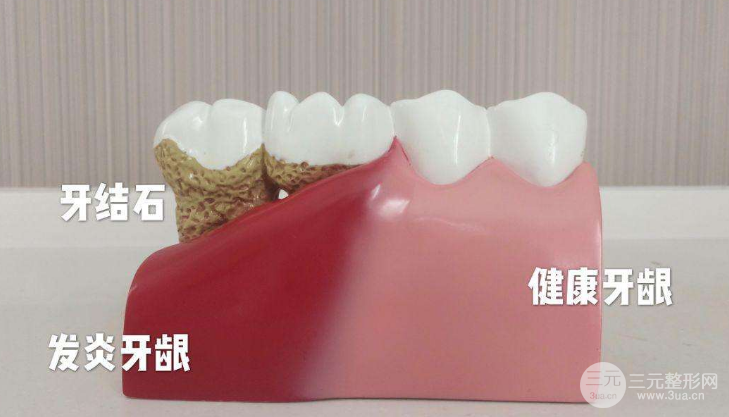 牙结石洗牙能洗掉吗？有什么危害