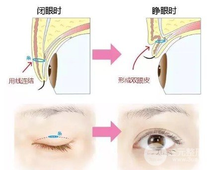 埋线双眼皮手术过程