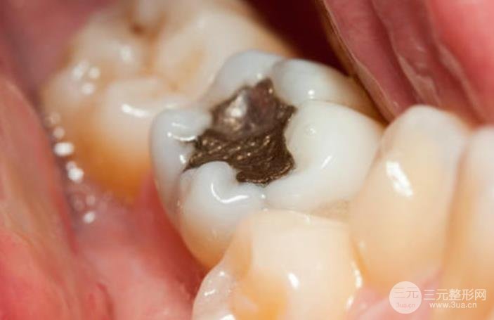 牙齿根部发黑可能是由牙根表面的龋齿引起的,缓解中,感染的黑牙组织要