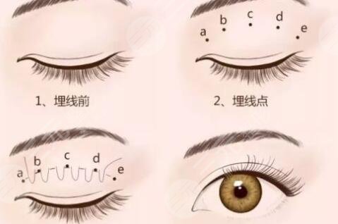 双眼皮手术类型