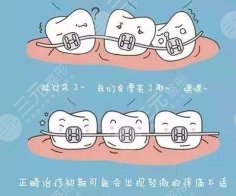 牙齿矫正的原理是什么?
