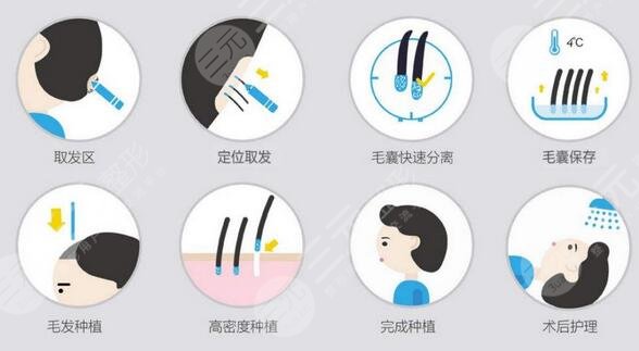 微针植发是什么技术微针植发后头发容易脱落吗