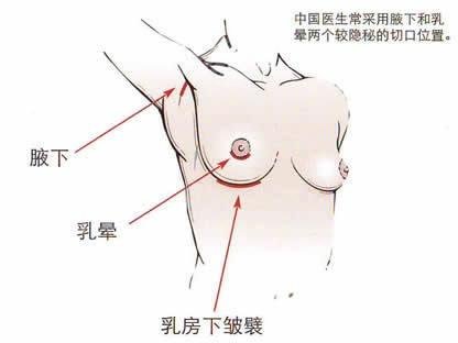 乳房整形有没有可以维持终生的呢？身材凹凸有致会增加女性的个人魅力
