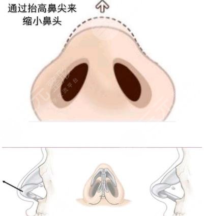 鼻头缩小手术的过程