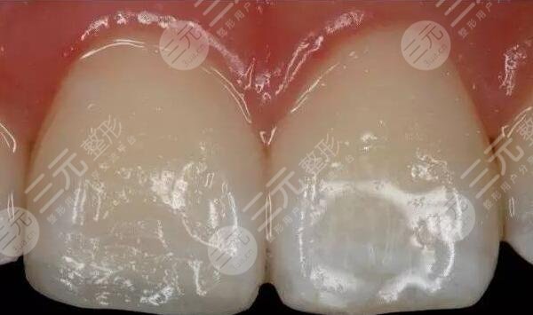 威海口腔医院美容科牙齿修复案例