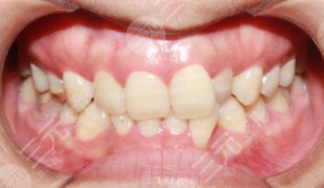 长春牙博士口腔医院牙齿矫正经历分享