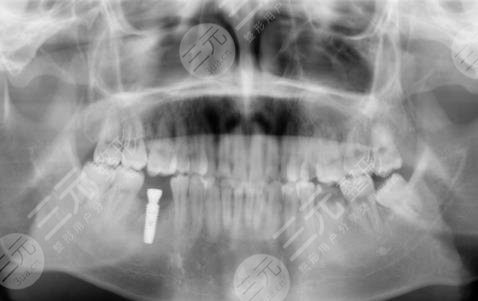 辽阳八一口腔医院牙齿种植手术分享