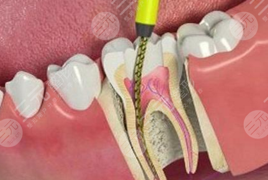 牙髓炎根管缓解的优势与缺点