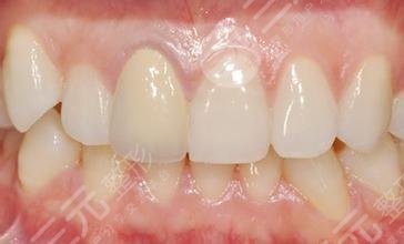 四环素牙会遗传吗