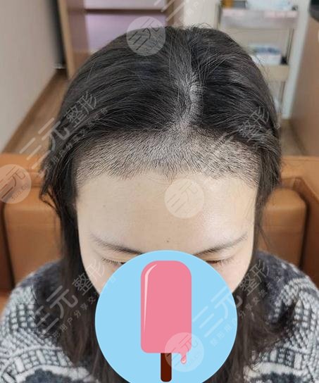 北京熙朵头发移植怎么样?附植发医生介绍 发际线移植经历分享