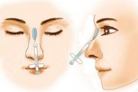 玻尿酸注射隆鼻好不好？玻尿酸注射隆鼻的优势及注意事项解析！
