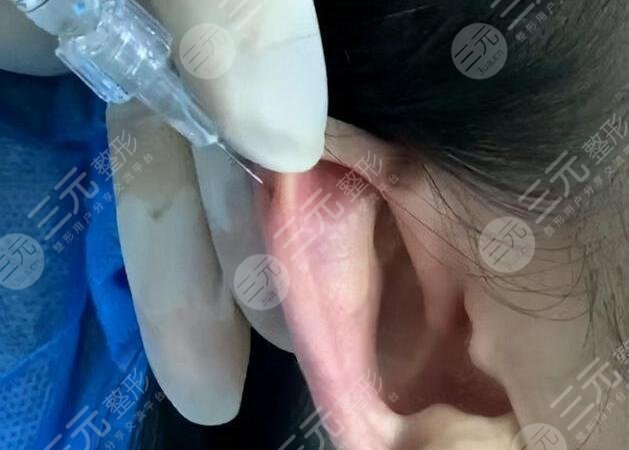 颅耳角在30°-60°之间手术缓解