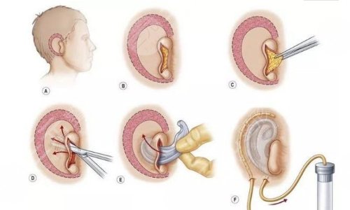 耳再造手术的过程