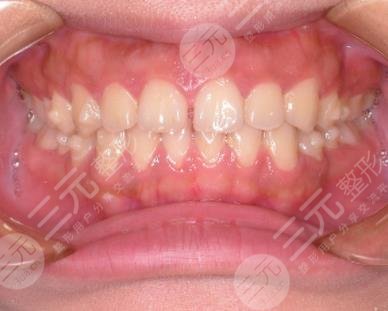 上海瑞泰口腔医院隐形牙齿矫正经历分享