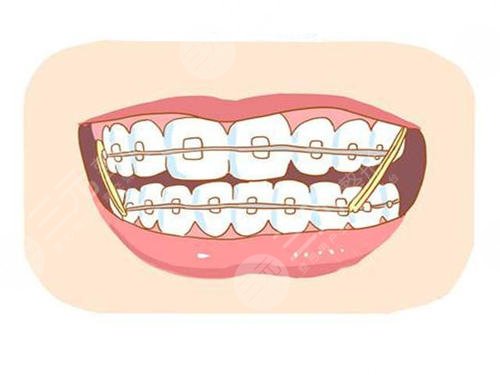 牙齿整形手术是什么?