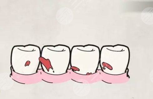 5类人不能做牙齿整形