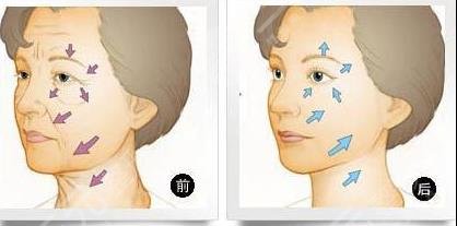 面部拉皮手术能保持多久