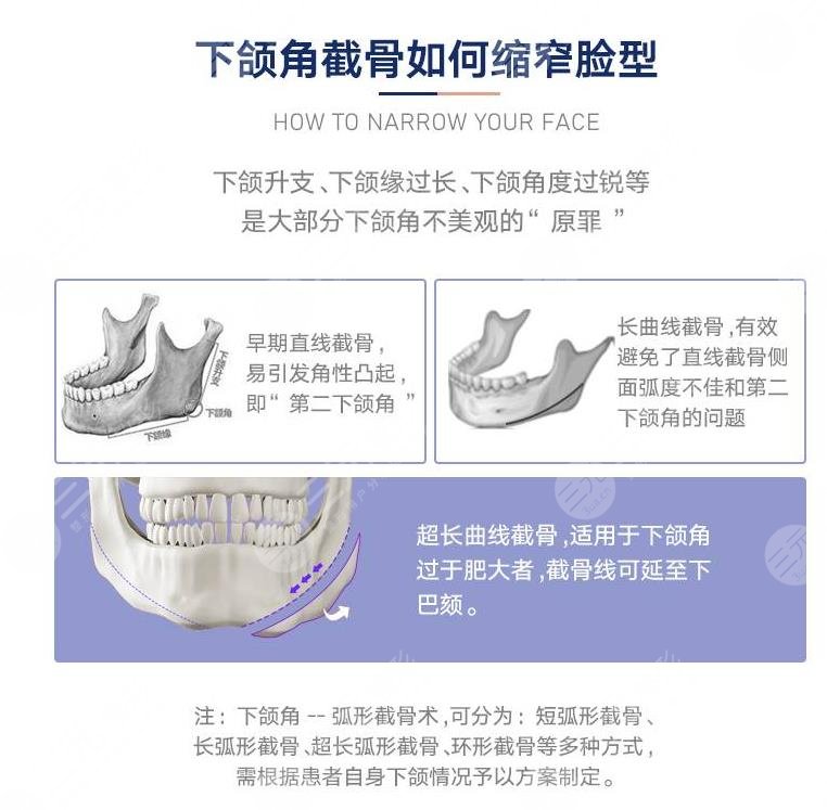 北京下颌角磨骨