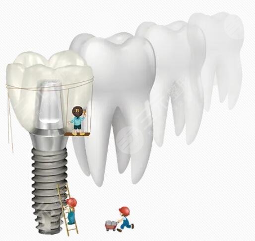 种植牙技术的手术优点