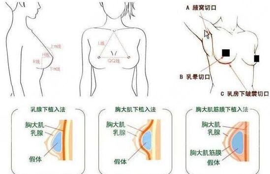 假体隆胸的过程