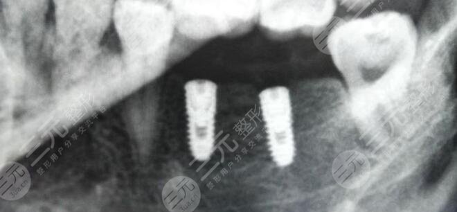 种植牙技术多久可以消肿?