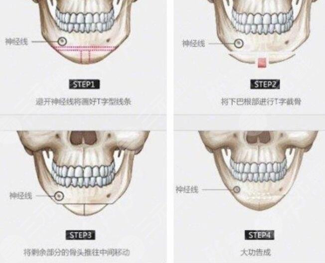 下颌角磨骨整形手术案例告诉你怎样变瓜子脸，精致小脸不是梦
