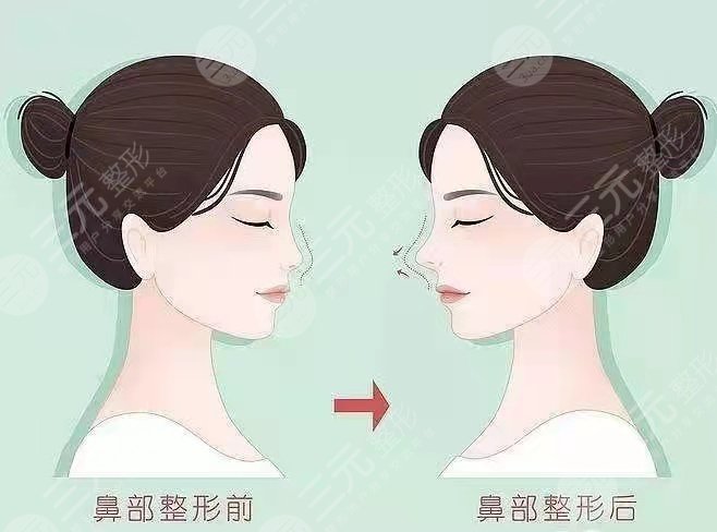 徐荣阳做鼻子案例图