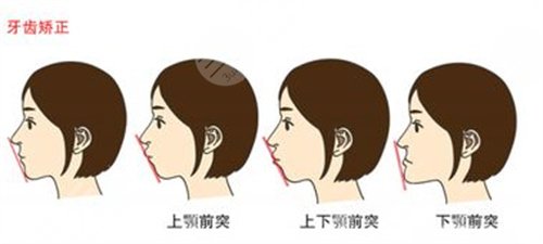 北京中诺口腔医院牙齿矫正案例