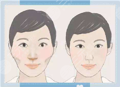 广州下颌角整形医生排名,下颌角手术案例