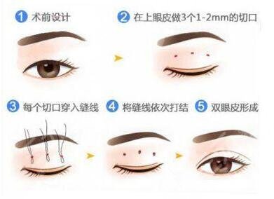西京医院整形科双眼皮案例