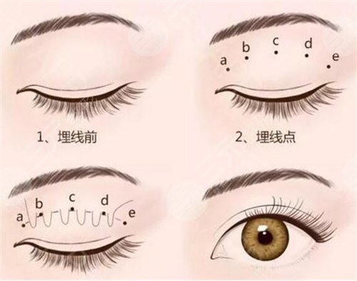 上海纽顿医疗美容双眼皮手术后1周