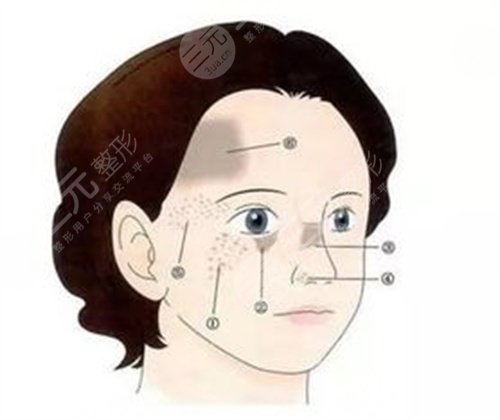 武汉大学人民医院整形科手术祛痣案例