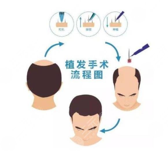 头发种植技术手术操作过程
