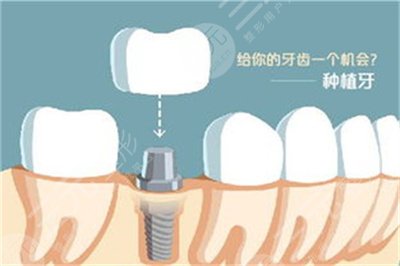 上海种植牙多少钱一颗2021
