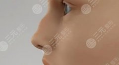 驼峰鼻手术一般多少钱？鼻部矫正整形价格参考！