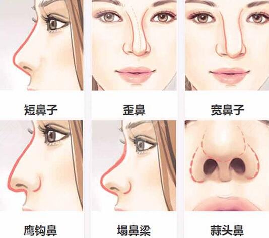 北京艾菲医疗美容诊所隆鼻案例:手术当天