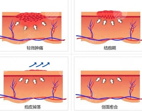 中山三院激光点痣一个多少钱挂谁的号茹扎黄胜华朱蕾信息介绍