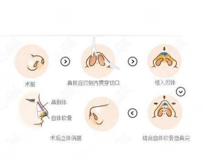 鼻部整形手术一般有哪些方法?